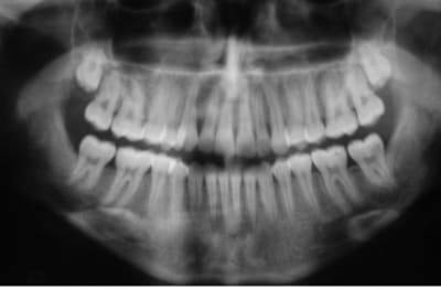 Impacted 8 emtkae - Eugenol