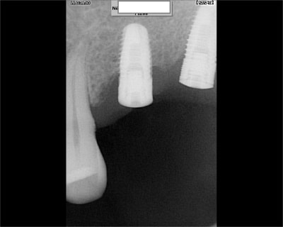 Implant222 qje8b0 - Eugenol