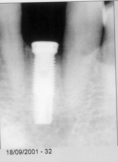 Implant 1 cy8pwg - Eugenol