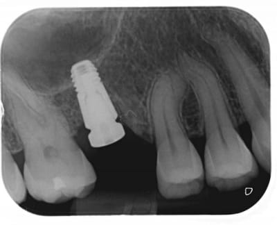 Implant 6 xzggle - Eugenol