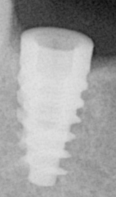 Implant ra   copie tgxakd - Eugenol