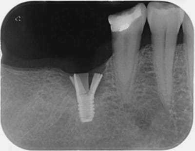 Implant astra jsdb6b - Eugenol