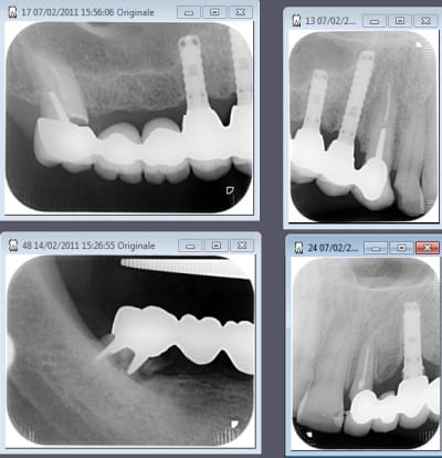 Implant dent s7cixa - Eugenol