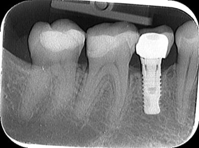 Implant inconnu zauhcj - Eugenol