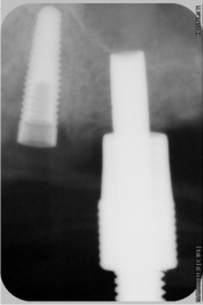 Implant lisse 23 osteotome 24 quusw0 - Eugenol