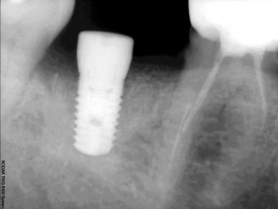 Implant mv1oeo - Eugenol