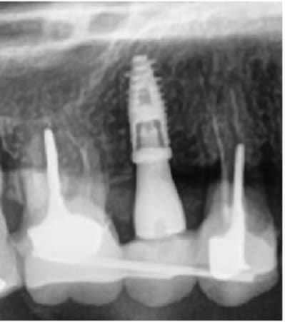 Implant p24lhh - Eugenol