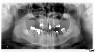 Implantoide1 kkunmo - Eugenol