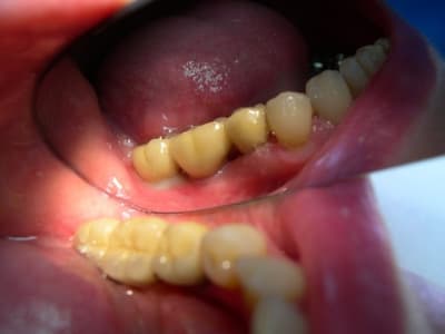 Implants 009 tmf7ni - Eugenol