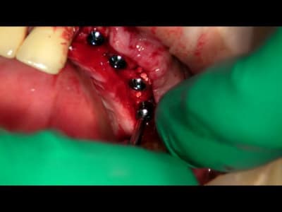 Implants pos s xluyxl - Eugenol