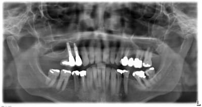 Implants vxehhy - Eugenol