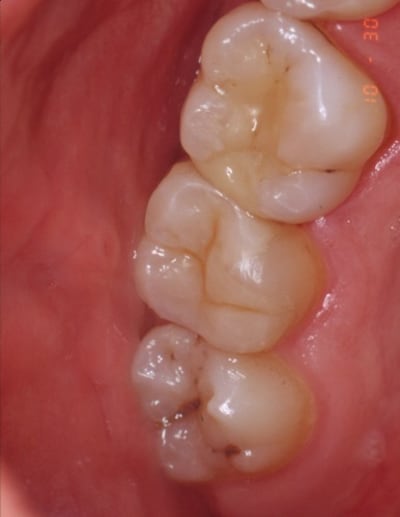 Inlay 2 rclrqc - Eugenol