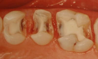 Inlay composite x5ssgc - Eugenol