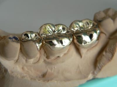 Inlays onlays u7vdtv - Eugenol