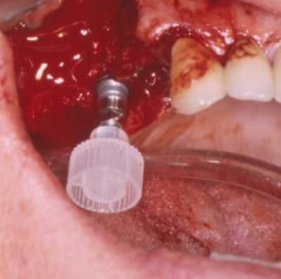 Insertion manuelle oqevht - Eugenol