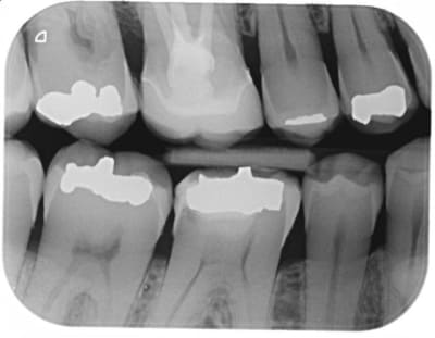 Intern resorption jh3vgx - Eugenol