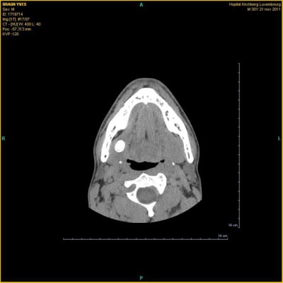 Kyste2 p972xp - Eugenol