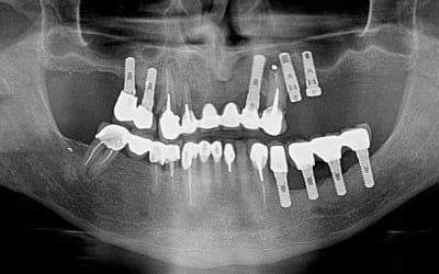 Kyste implant iewzdt - Eugenol