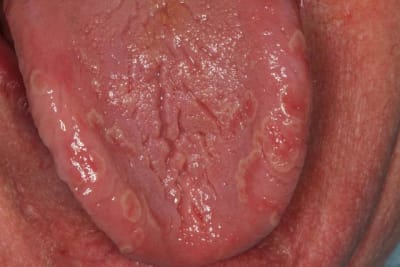 Langue cplcgz - Eugenol