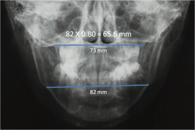 Mini frontal voberd - Eugenol