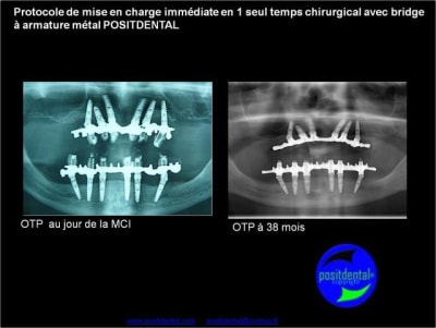 Mise en charge imm diate en 1 seul temps chirurgical avec bridge   armature m tal positdental cdfcrj - Eugenol