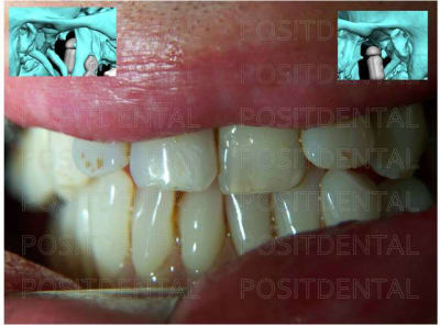 Mise en charge imm diate en chirurgie implantaire guid e 012 dh47wr - Eugenol