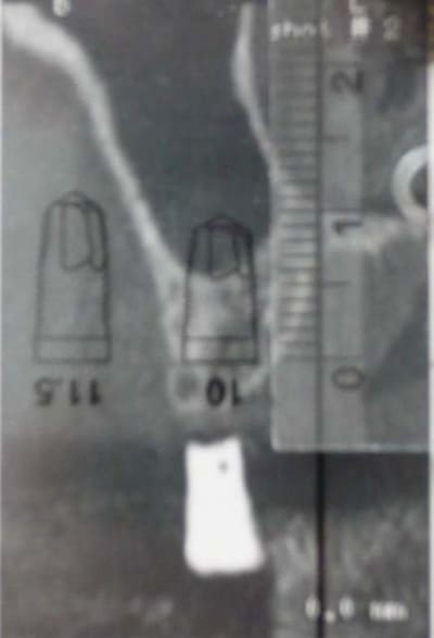 Molaire1 nfswdm - Eugenol