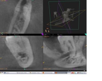 Nerf dentaire q9vdbp - Eugenol
