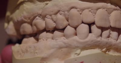 Occlusion d tphfvt - Eugenol
