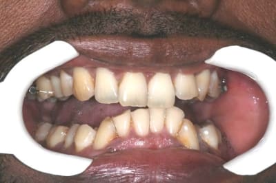 Occlusion nkkyjb - Eugenol