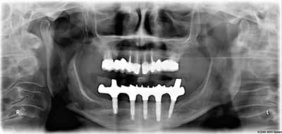 On 5 zyll5u - Eugenol