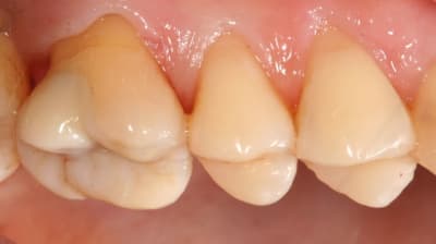 Onlay084 tjk84f - Eugenol