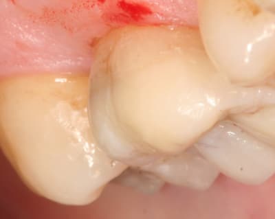 Onlay085 rjxkyu - Eugenol