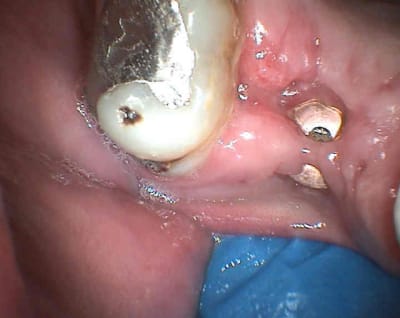 Operculisation mzug6r - Eugenol
