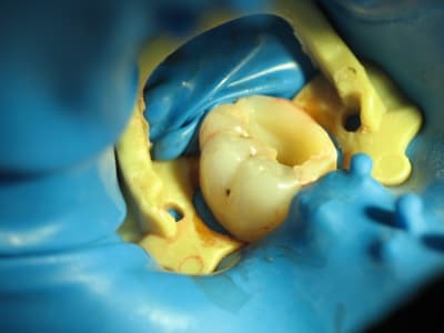 Optidam et clamp kerr sevnnr - Eugenol