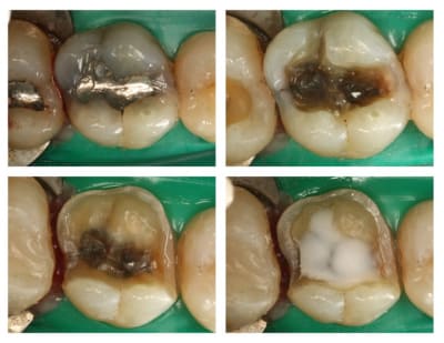 Option 2 xycnej - Eugenol