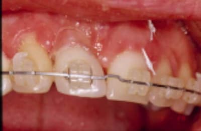 Ortho imp 2 hmbaph - Eugenol