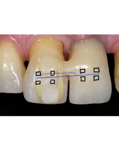 Ortho mnnddl - Eugenol