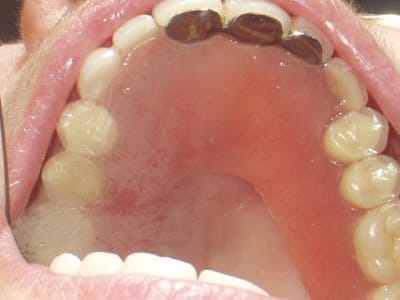 Overdenture  1  iun5fu - Eugenol