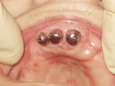 Overdenture  2  qnlten - Eugenol