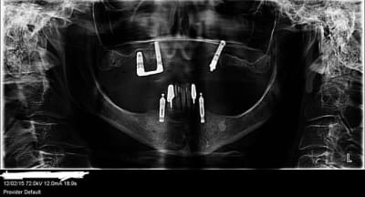 Pano identification implant vbynsc - Eugenol