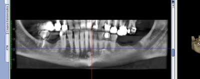 Pano implant g1btrh - Eugenol