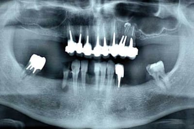 Pano vlqcnw - Eugenol