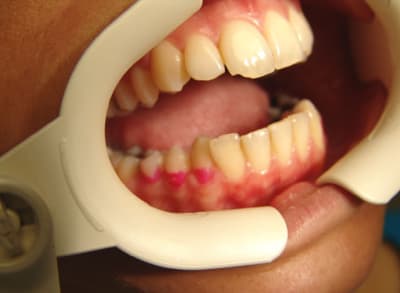 Paro elfce1 - Eugenol