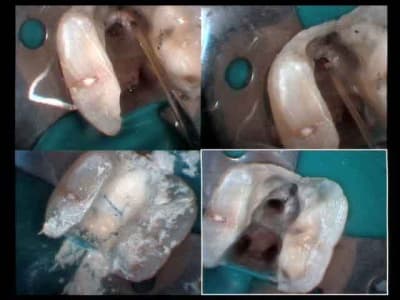 Perdue or not perdue  laser sur la fissure et n2  biuzdj - Eugenol