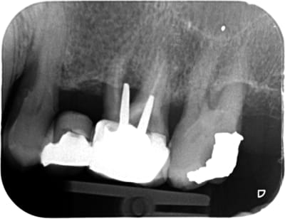 Petite perforation qui va bien g4h5db - Eugenol