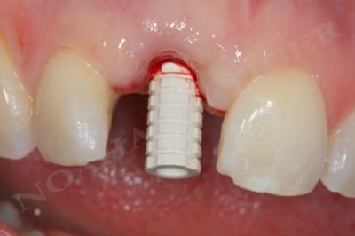 Pilier provisoire pl5lvv - Eugenol