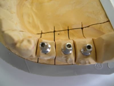 Piliers vue occlusale d69nv4 - Eugenol
