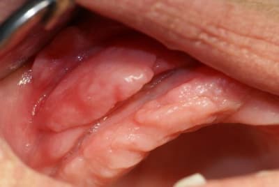 Pli lamelle kn4oib - Eugenol