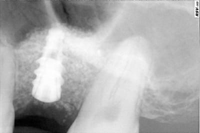 Pose implant wzyx5t - Eugenol